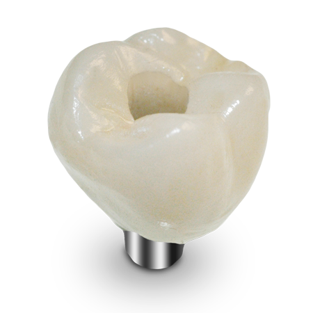 Screw-RetainedCrown ArgenZ ST Multilayer Milled Zirconia